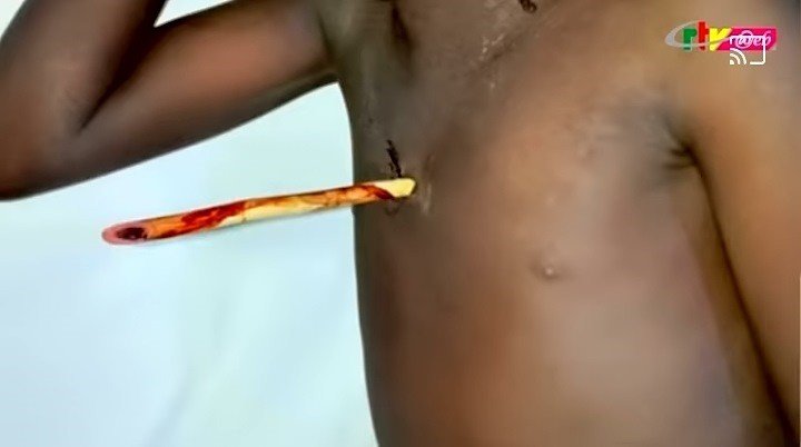  Cameroun : Une fillette de 9 ans opérée à cœur ouvert pour retirer une flèche de 16 cm de long